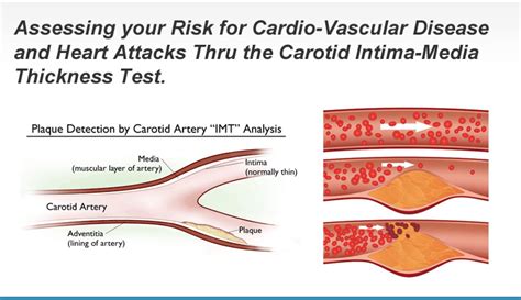 mobile intimal media thickness testing|carotid intima media thickening.